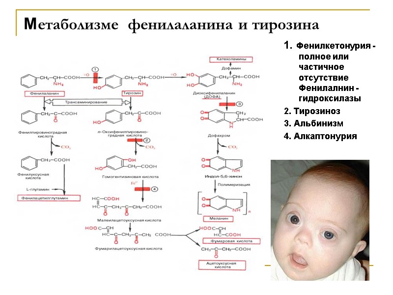 Метаболизме  фенилаланина и тирозина 1. Фенилкетонурия - полное или частичное отсутствие Фенилалнин -гидроксилазы